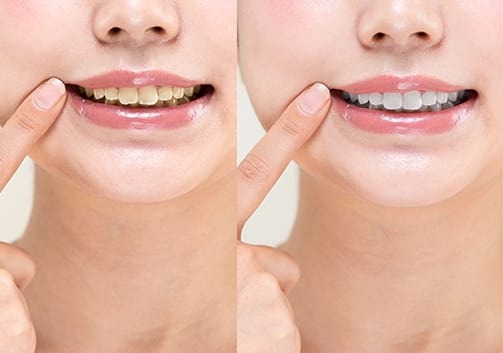 セルフホワイトニングとは２